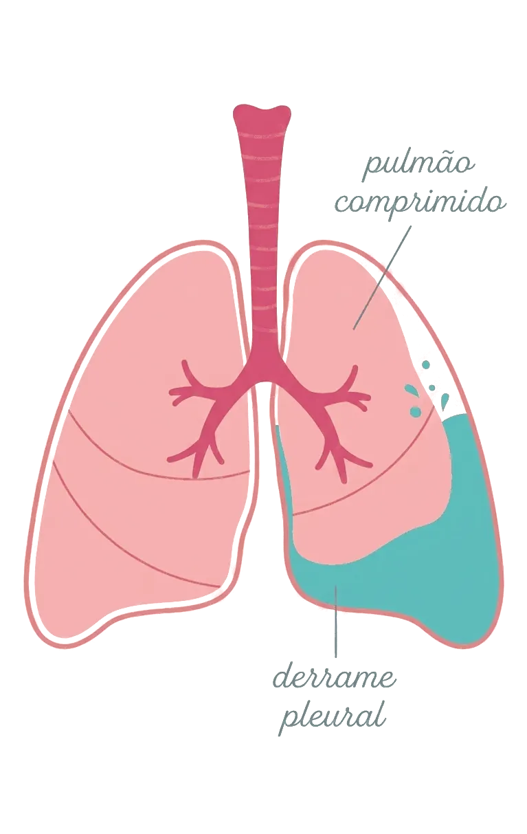 Ilustração de derrame pleural — acúmulo de líquido na cavidade pleural