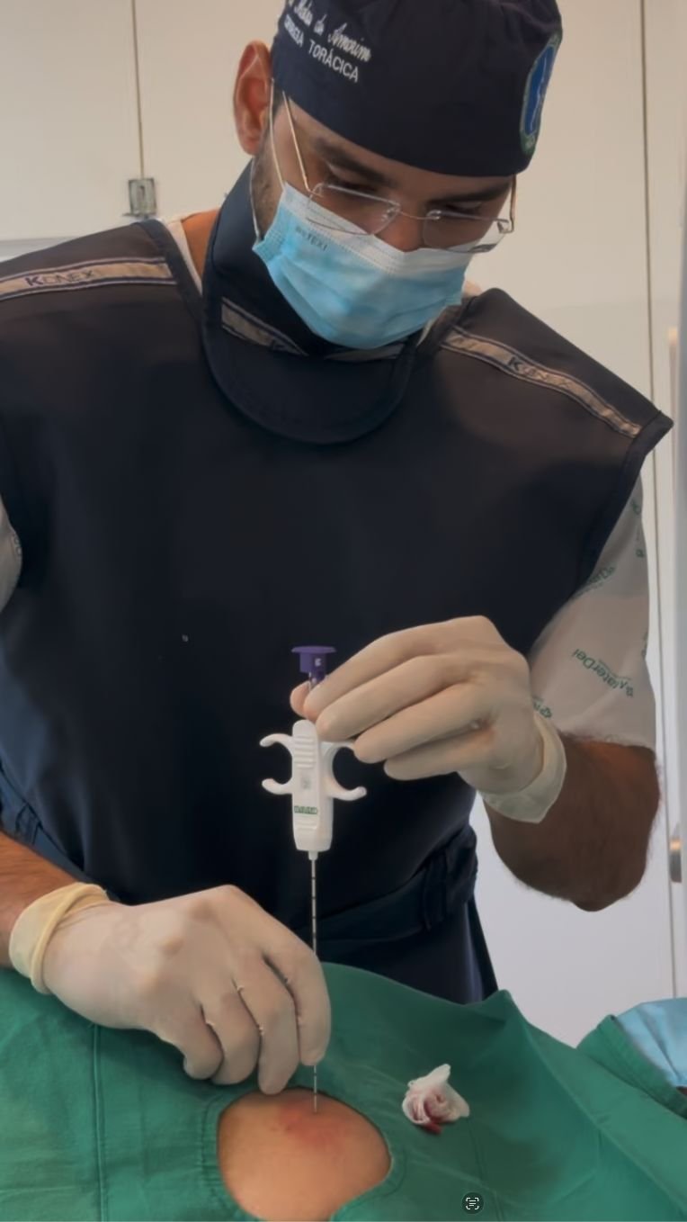 Biópsia percutânea para nódulo pulmonar — orientada por tomografia