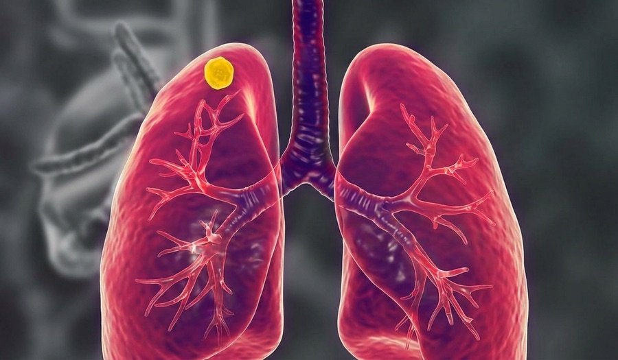 Ilustração de nódulo pulmonar — pequena lesão no tecido pulmonar
